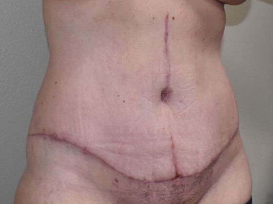 Tummy Tuck (Abdominoplasty): Case 515 - After