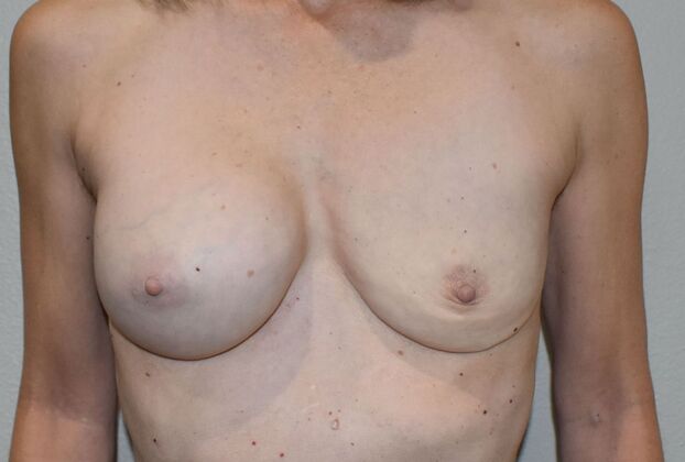 Breast Revision: Case 267 - Before