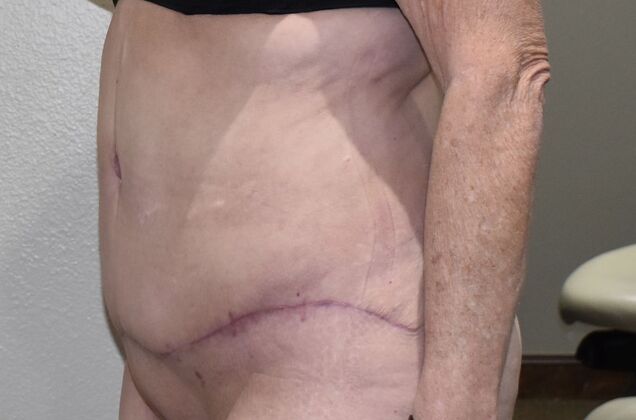 Tummy Tuck (Abdominoplasty): Case 507 - After