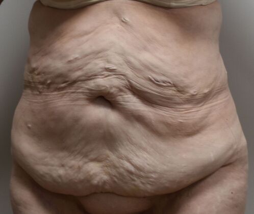 Tummy Tuck (Abdominoplasty): Case 507 - Before