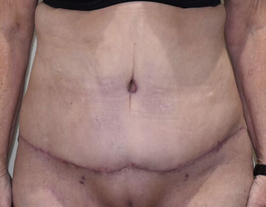 Tummy Tuck (Abdominoplasty): Case 507 - After