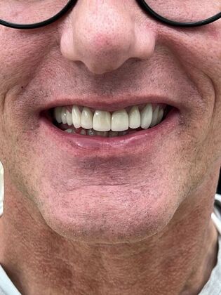 Dental Bridges Cases