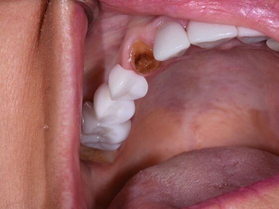 Dental Bridges Lori - Before