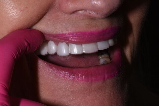 Dental Bridges Lori - After