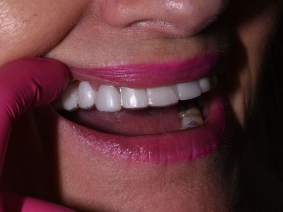 Dental Bridges Cases
