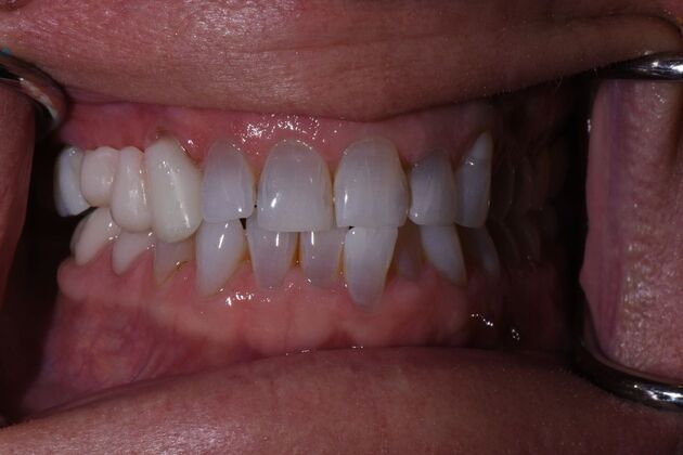 Dental Bridges Judy - Before