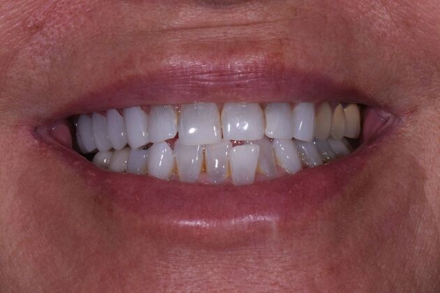 Dental Bridges Judy - After