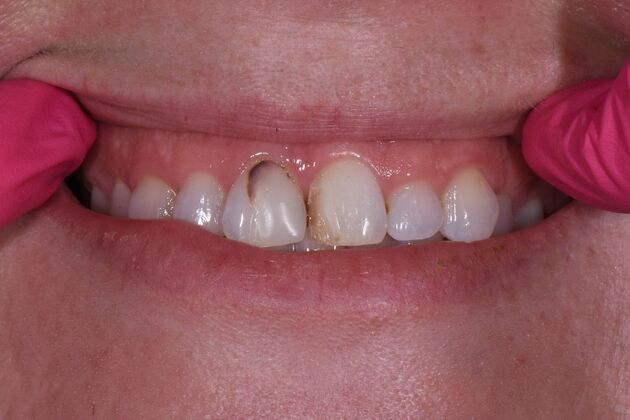 Fillings Melisa - Before