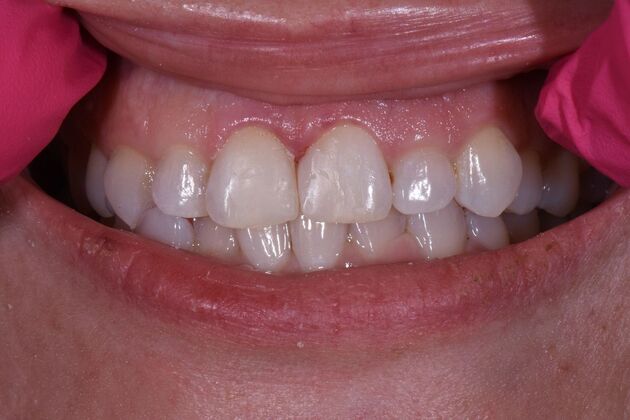 Fillings Cases