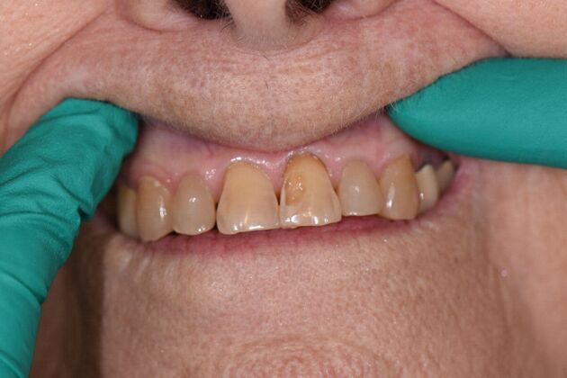 Fillings Genelle - Before