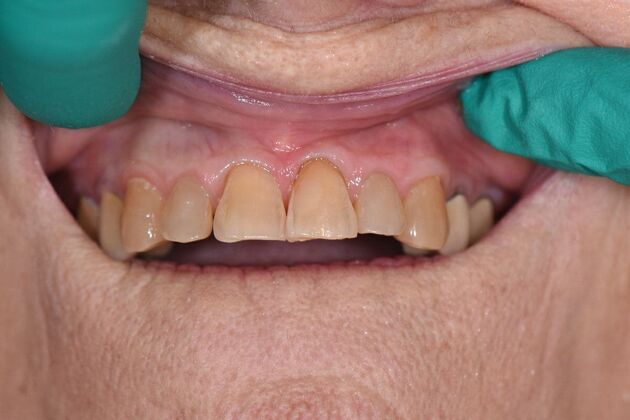 Fillings Genelle - After