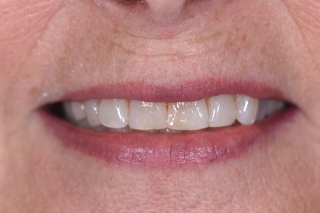 Fillings Gail - After