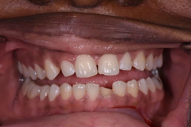 Dental Crowns Shanique - Before