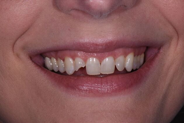 Dental Crowns Sarah - Before