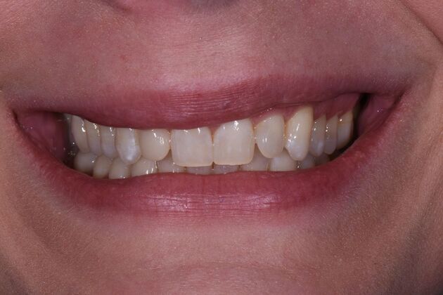 Dental Crowns Sarah - After