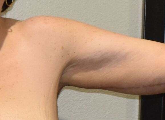 Brachioplasty Case 23 - After