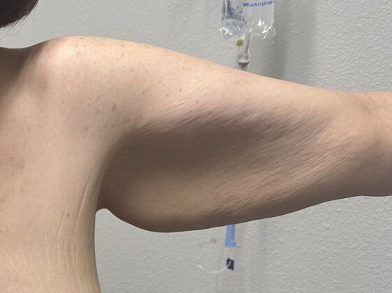 Brachioplasty Case 23 - Before