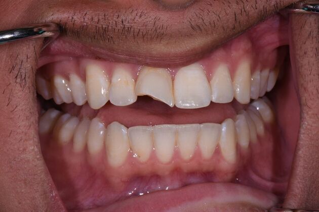 Dental Crowns Martin - Before