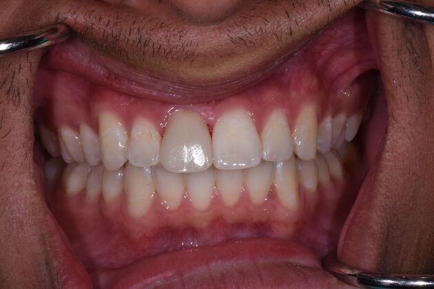 Dental Crowns Martin - After