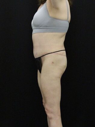 Body Lift: Case 7 - After