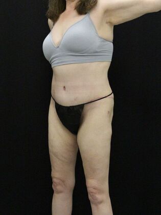 Body Lift: Case 7 - After