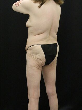 Body Lift: Case 7 - Before