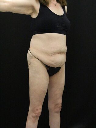 Body Lift: Case 7 - Before