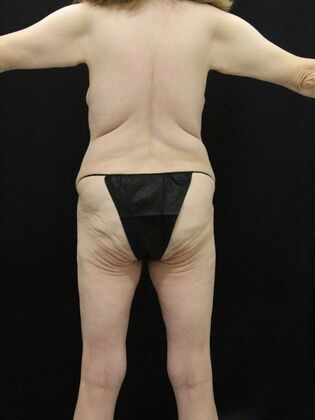 Body Lift: Case 7 - Before