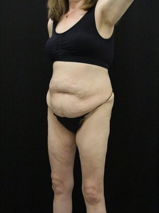 Body Lift: Case 7 - Before