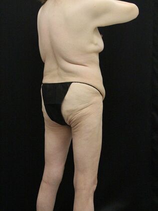 Body Lift: Case 7 - Before