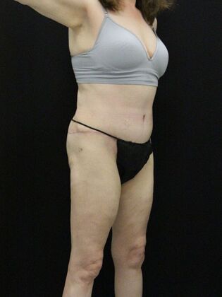 Body Lift: Case 7 - After