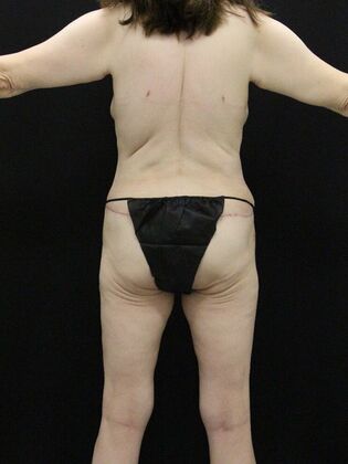 Body Lift: Case 7 - After