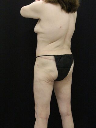 Body Lift: Case 7 - After