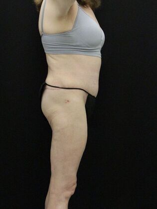 Body Lift: Case 7 - After