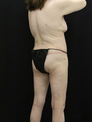 Body Lift: Case 7 - After