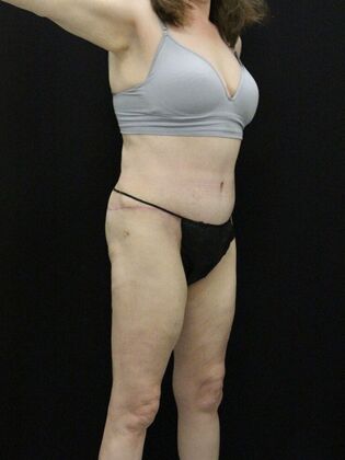 Tummy Tuck: Case 62 - After