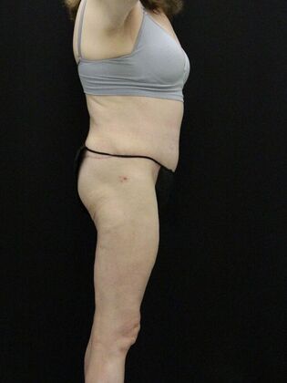 Tummy Tuck: Case 62 - After