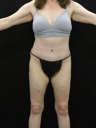 Tummy Tuck Case 62 - After