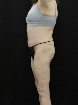 Tummy Tuck: Case 62 - After