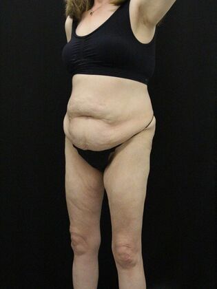 Tummy Tuck: Case 62 - Before