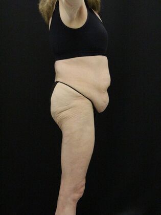 Tummy Tuck: Case 62 - Before