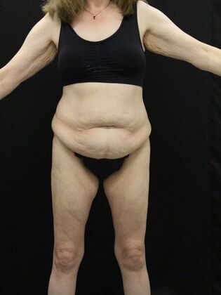 Tummy Tuck Case 62 - Before