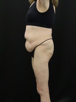 Tummy Tuck: Case 62 - Before