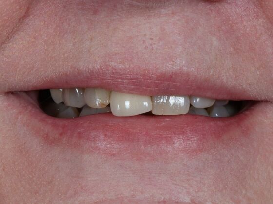 Dental Implants: Suzanne - Before