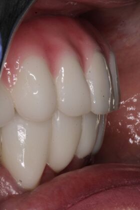 Dental Implants: Suzanne - After