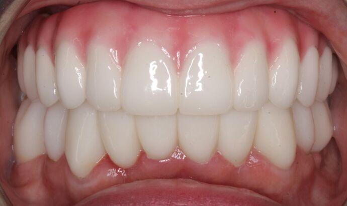 Dental Implants: Suzanne - After