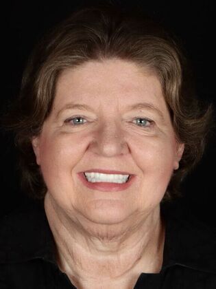 Dental Implants Suzanne - After