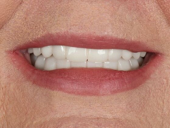 Dental Implants: Suzanne - After