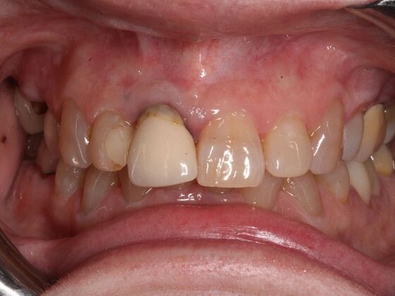 Dental Implants: Suzanne - Before