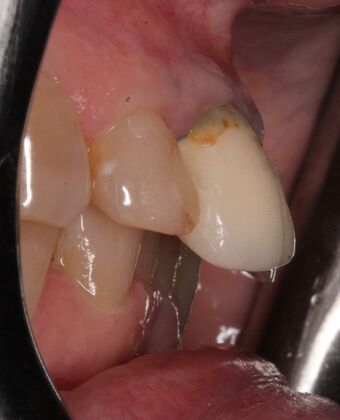 Dental Implants: Suzanne - Before